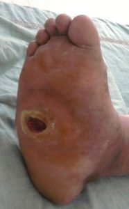 Diabetic Charcot Foot Ulcer 