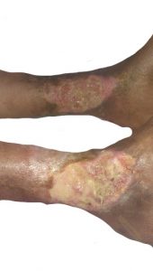 Ulcers in Rheumatoid Arthritis