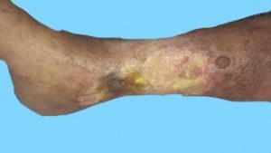 Ulcer in rheumatoid Arthritis
